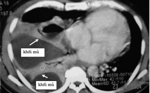Nhận biết sớm viêm mủ màng phổi
