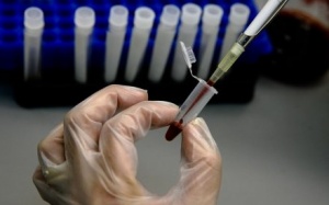 Những lưu ý trước khi làm xét nghiệm