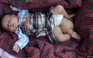 TQ: Bé sơ sinh 3 chân bị bỏ rơi