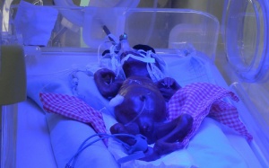 Cháu bé sinh non suýt bị chôn sống đã tử vong