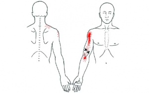 Viêm gân khớp vì chơi thể thao sai cách