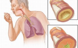 Viêm phế quản có thể chữa bằng Tiêu Khiết Thanh không?