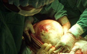 Giảm 23 kg chỉ sau một cuộc phẫu thuật!