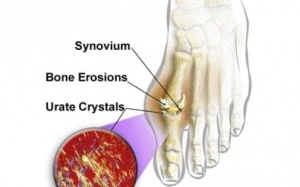 Nên uống Hoàng Thống Phong trong bao lâu?