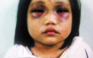 Bé gái 5 tuổi  bị cha hành hạ tàn nhẫn