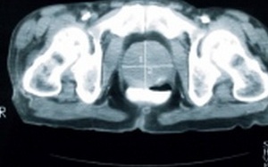 Phát hiện sớm tế bào ung thư bằng âm thanh