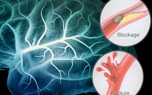 Vắc xin phòng cúm có thể giúp giảm nguy cơ đột quỵ