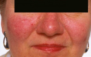 Đỏ mặt chẳng bởi thẹn thùng...