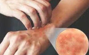 Phòng bệnh dị ứng do ánh nắng