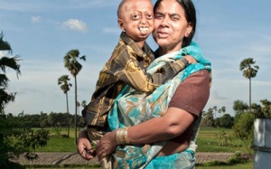 'Cụ già' 14 tuổi trong gia đình 6 anh chị em đều mắc bệnh 'hiểm'