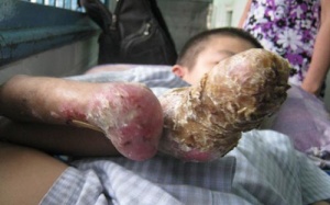 Hội chẩn quốc tế cứu chàng trai 'rụng' dần tứ chi