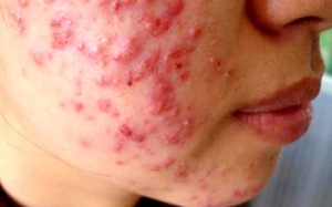 Những hình ảnh ghê rợn từ lột da tắm trắng