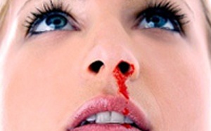 Đừng chủ quan với chảy máu cam