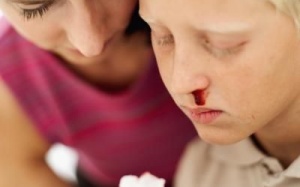 Vì sao trẻ bị chảy máu cam?