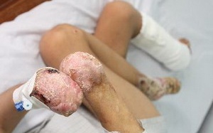 Phát hiện bệnh gây hoại tử tứ chi tại TP Hồ Chí Minh