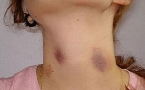 Nên thận trọng với những vết bầm tím trên da