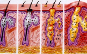 Hơn 96% người bị trứng cá nặng do bôi corticoid