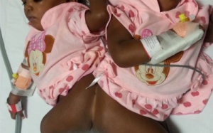 Tách thành công cặp song sinh dính liền xương sống