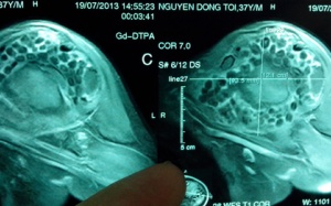 Mổ nội soi lấy gần 300 viên sỏi trong khớp vai