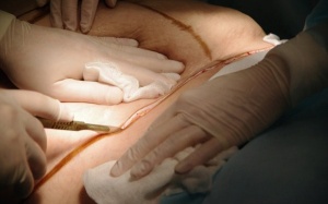 Cận cảnh của phẫu thuật hút mỡ, căng da