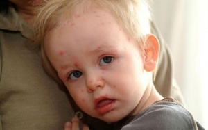 Phòng chốc lở ở trẻ em