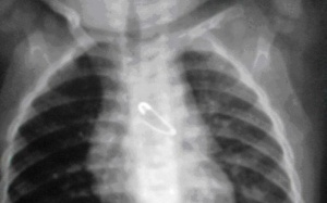 Bé 6 tháng tuổi nuốt kim băng 2 cm