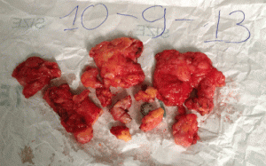 Hại thân vì bơm ngực bằng 'mỡ nhân tạo'