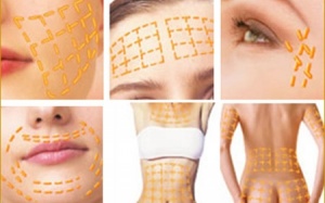 Căng da bằng lưới chỉ vàng 24k - đẹp hay độc?