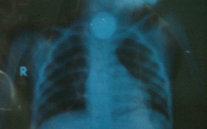 Bé trai bị mắc đồng xu trong thực quản hơn 1 năm