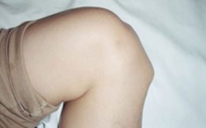 Viêm khớp ở trẻ em: Phát hiện muộn, dễ gây tàn phế