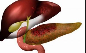 Dấu hiệu bất thường cảnh báo ung thư tuyến tụy