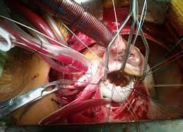 Hơn 19 tỷ đồng ủng hộ trẻ em bị bệnh tim bẩm sinh