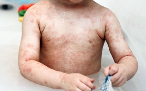 Dị ứng thức ăn ở trẻ nhỏ