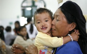 Chăm sóc trẻ sứt môi - hở vòm sau phẫu thuật