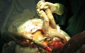 Mẹ bị cắt tử cung, con tử vong sau mổ