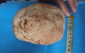 An Giang: Lấy thành công viên sỏi gần 1kg ra khỏi bàng quang