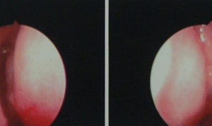 Điều trị viêm xoang, bị cắt… polyps