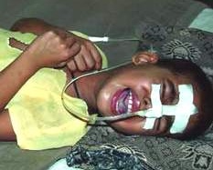 Viêm não Nhật Bản - Không nên lo lắng quá mức