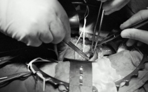 Ghép thận từ bé 5 tuần tuổi cho người lớn