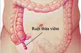 Đà Nẵng: Phẫu thuật thành công ca viêm ruột thừa có phủ tạng đảo ngược