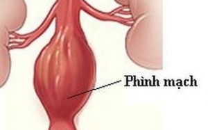 Điều trị phình động mạch chủ ngực bằng kỹ thuật mới