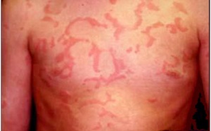 Bị mề đay 10 năm dùng Phụ Bì Khang có khỏi được không?