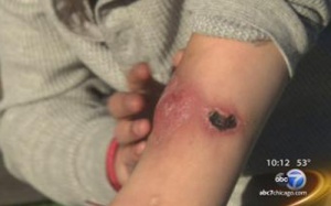 Mỹ: Bùng phát 'ma túy cá sấu' khiến cơ thể lở loét