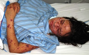 Viêm màng não mô cầu có thể giết người chỉ trong 1 ngày