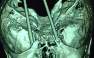 Phẫu thuật lấy đôi đũa đâm xuyên não bệnh nhân