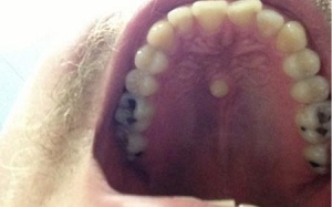 Hi hữu 'răng cá mập' mọc giữa... vòm miệng