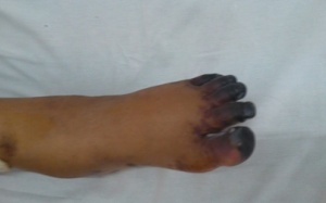 Phải tháo khớp 5 ngón chân vì hoại tử do cắt lễ