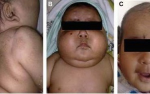 Glucocorticoid - con dao 2 lưỡi