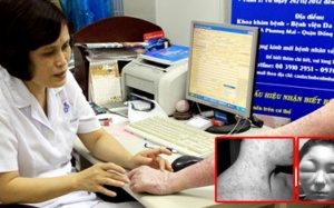 Viêm da tiếp xúc, coi chừng nhập viện