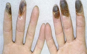 Cụt chân tay vì thuốc lá